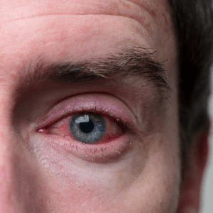 LENS KULLANIM SURESI GECERSE NE OLUR