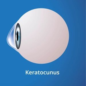Keratokonus